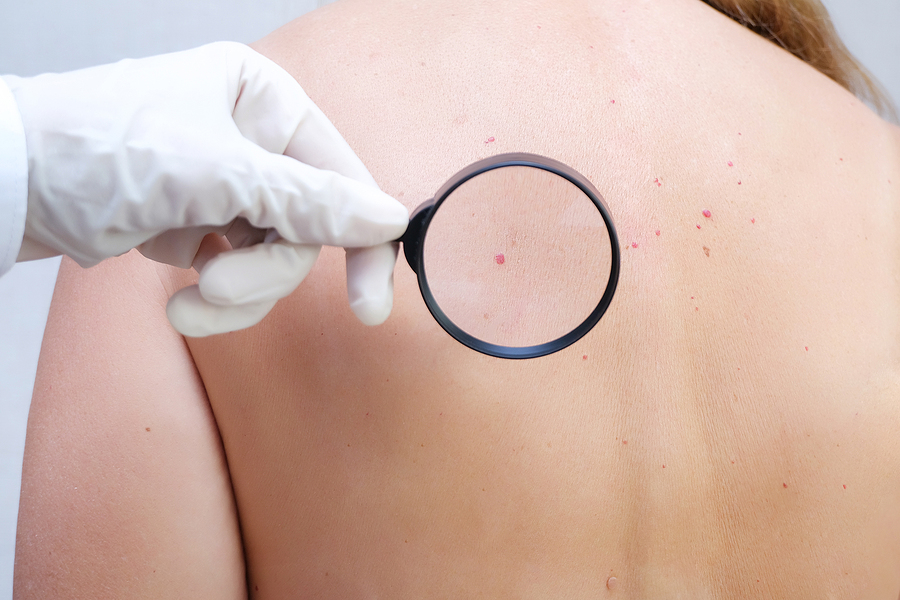 Doctor doing a mole mapping to a woman's back